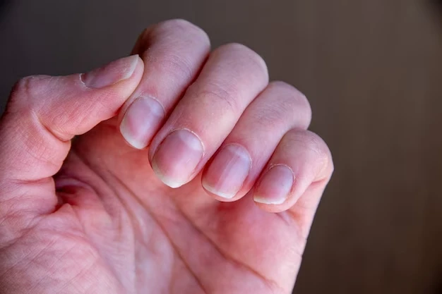 tratamento para unhas quebradiças