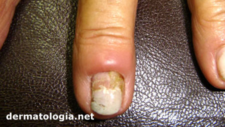 Paroníquia: Causas, Sintomas e o Tratamento Ideal para a Inflamação da Unha