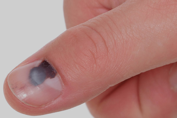 Micose de Unha (Onicomicose): Como Identificar e Tratar a Infecção Fúngica