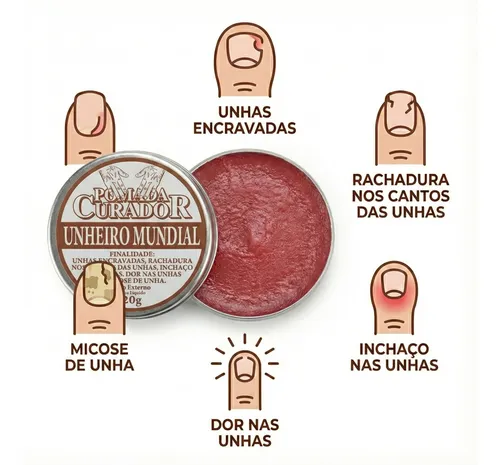 Micose de Unha (Onicomicose): Como Identificar e Tratar a Infecção Fúngica