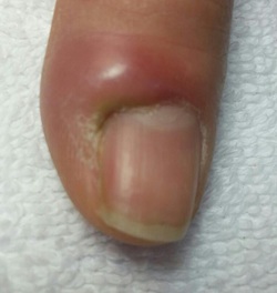 Paroníquia: Causas, Sintomas e o Tratamento Ideal para a Inflamação da Unha