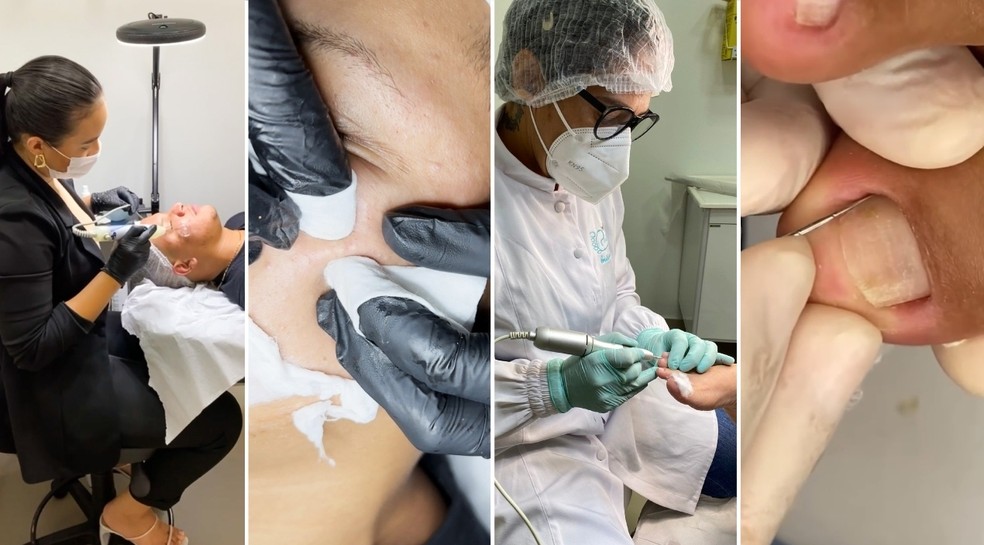 video de unha encravada